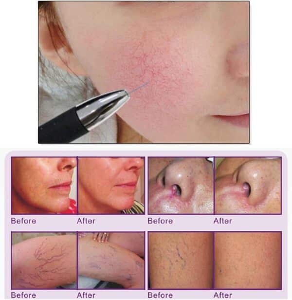 Qiang Instrument Laser à Radiofréquence, Outils De Thérapie RF à Haute Fréquence,Machine De Beauté Vasculaire/Veines D'araignée/élimination du Sang Rouge