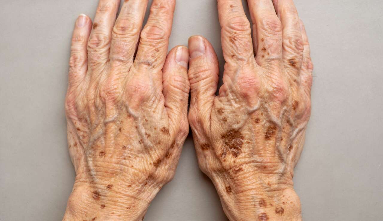 Causes et sympt&ocirc;mes des taches de vieillesse